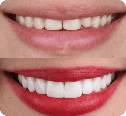 antes y despues diseño de sonrisa