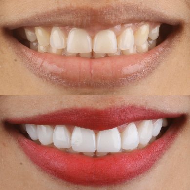 antes y despues carillas dentales