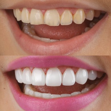 antes y despues carillas dentales