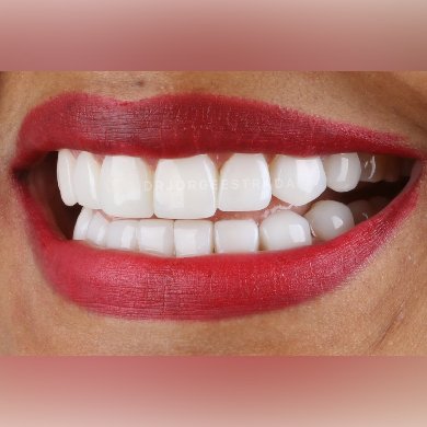 implantes dentales resultados