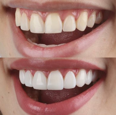 antes y despues carillas dentales