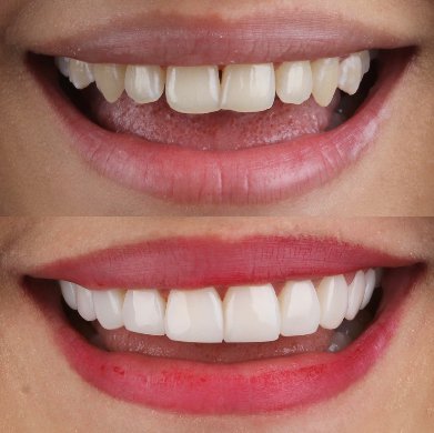 antes y despues diseño de sonrisa