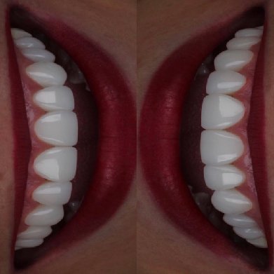 implantes dentales resultados